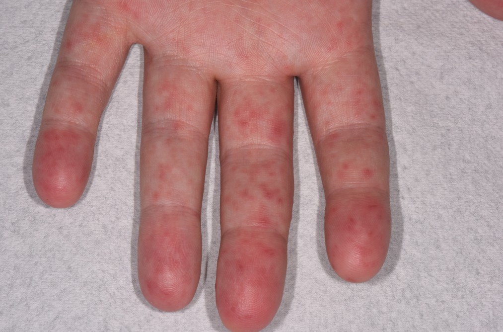 아이 온몸에 ‘발진’ 일어난다면, 수족구병 의심…“낫기 전 어린이집 등원 금물”