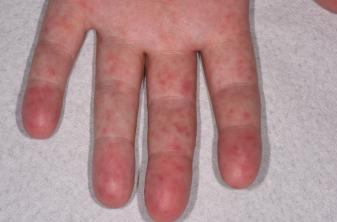 영유아 발진 증세 (사진=클립아트코리아)